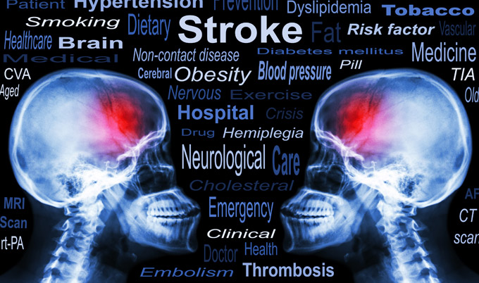 X-ray skull with 'stroke' and medical text
